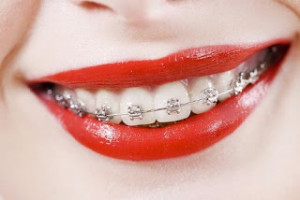 braquetes-de-aparelho-dentario-ortodntico-dental-fio_MLB-O-3860939072_022013